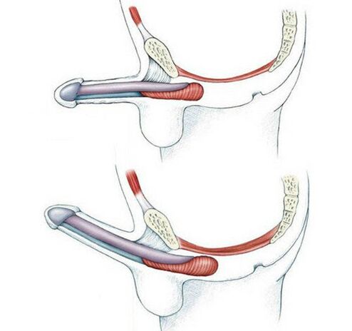 Pénis sans entraînement du muscle pubococcygien et ensuite