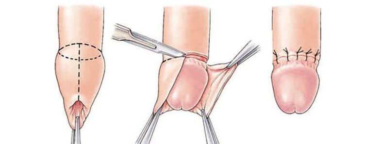L'effet de la circoncision sur la taille du pénis